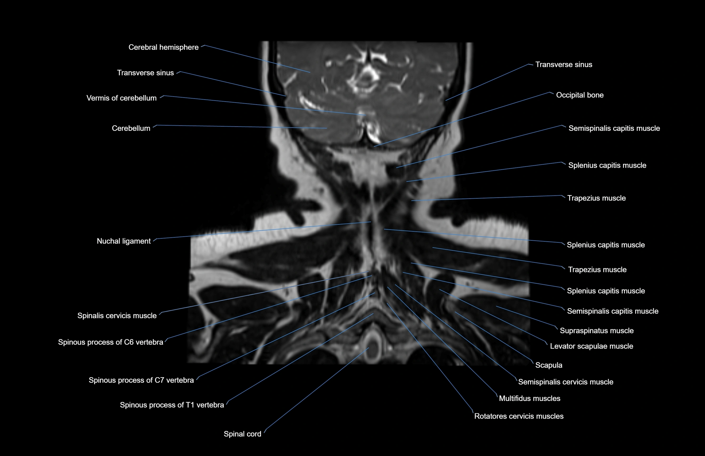 Neck coronal cross sectional MRI anatomy 3T MRI  image-img-00001-00008.webp
